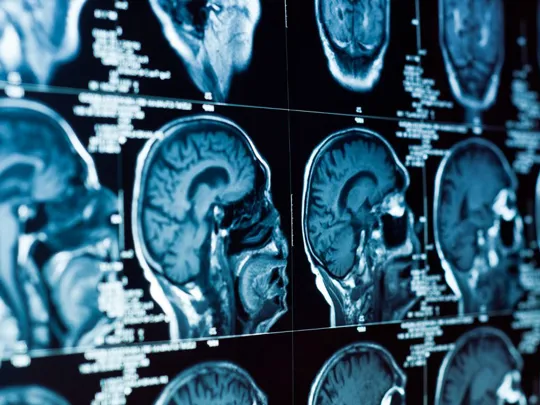 A close-up view of multiple brain scans arranged in a grid. The scans are in blue and white tones, showing various cross-sections and angles of a human head and brain.