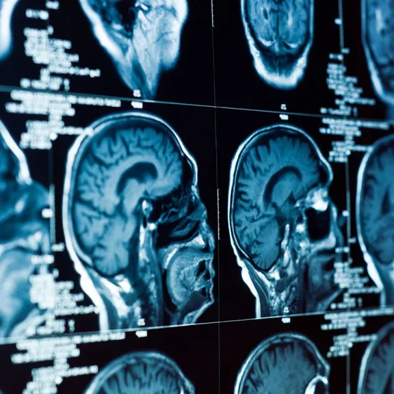 A close-up view of multiple brain scans arranged in a grid. The scans are in blue and white tones, showing various cross-sections and angles of a human head and brain.